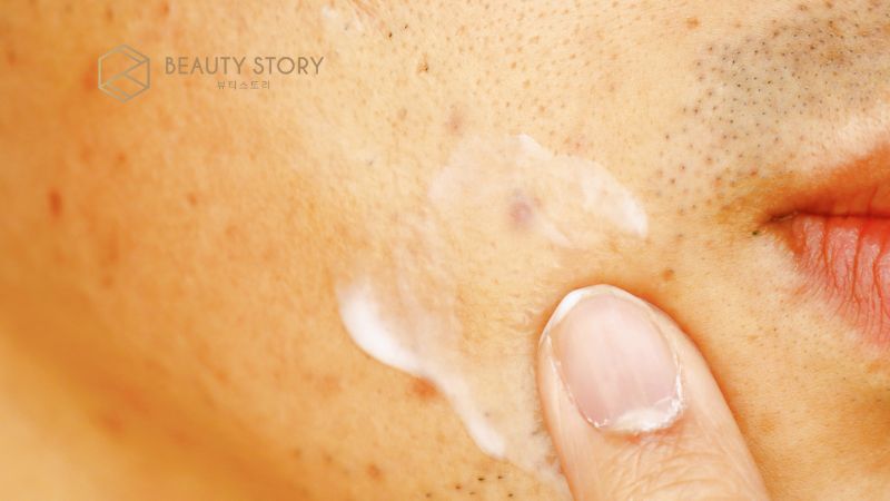 Cách làm hết mụn thâm