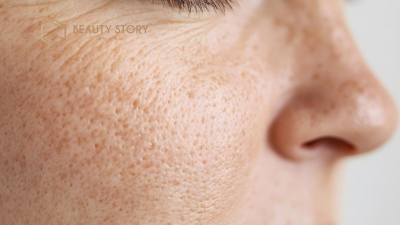 Cách trị nám gò má tại nhà