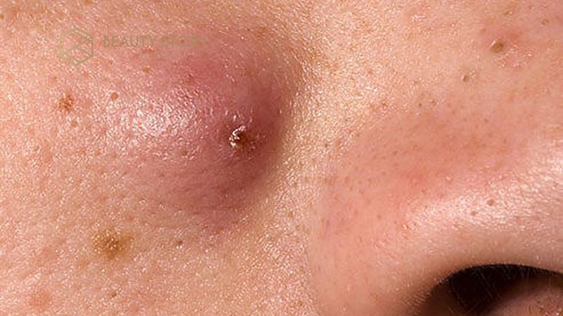 Cách xử lý mụn đinh râu an toàn