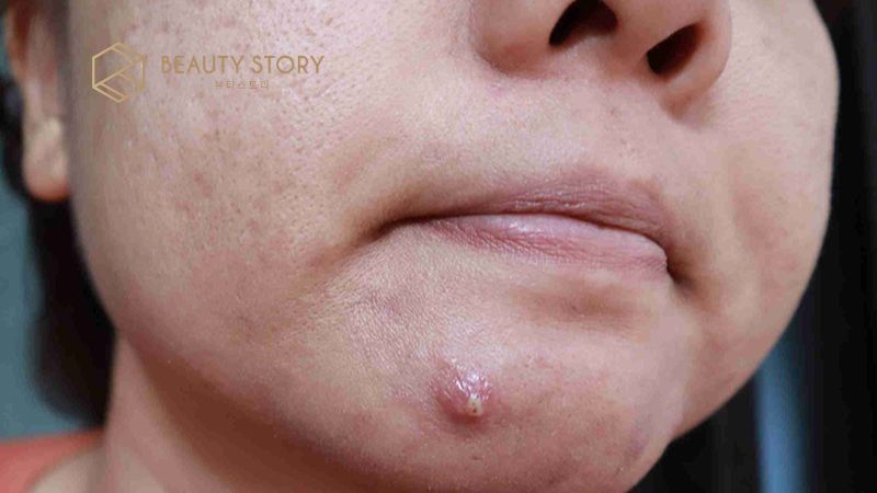 Dấu hiệu mụn sưng đỏ