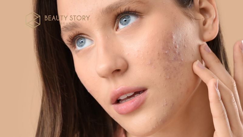 Mụn ẩn có tự hết không