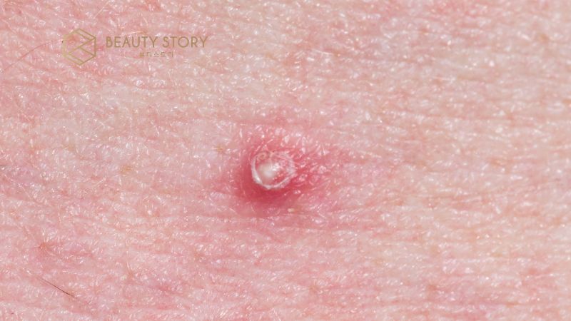 Mụn bọc không đầu xử lý thế nào