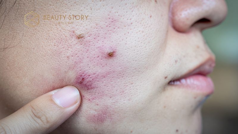 Mụn bọc không đầu xử lý thế nào