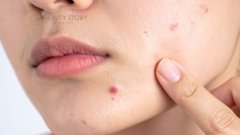 Nguyên nhân gây mụn