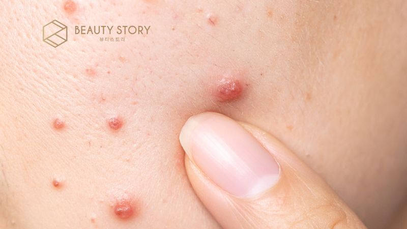 Nguyên nhân gây mụn