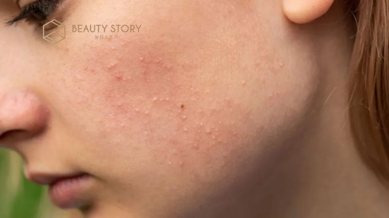 Nổi mụn nước trên mặt