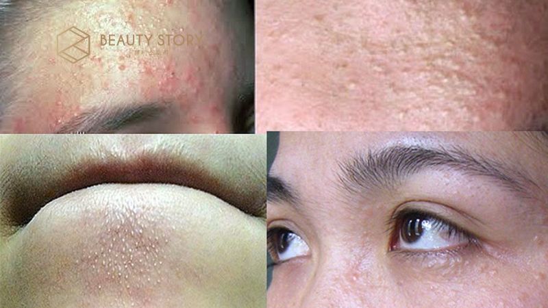 Nổi mụn nước trên mặt