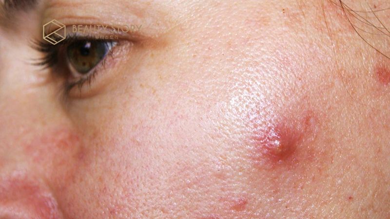 Phác đồ điều trị mụn nang