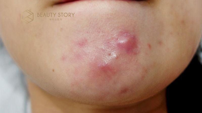 Phác đồ điều trị mụn nang