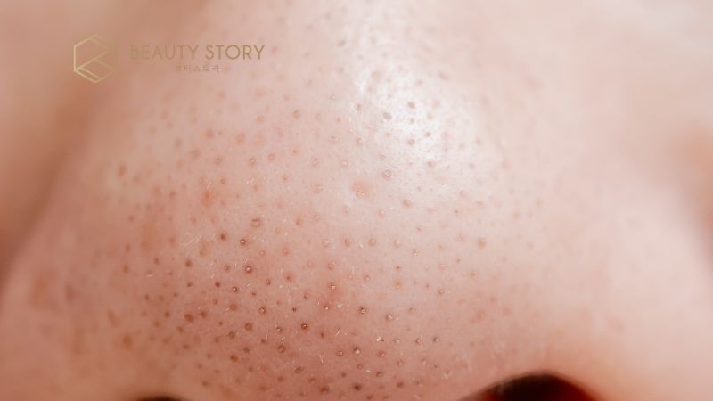 Phân biệt mụn đầu đen và sợi bã nhờn