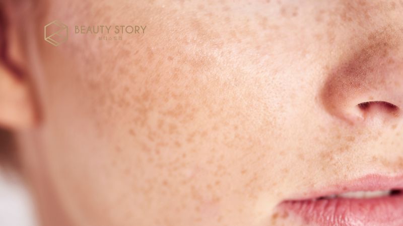 Phân biệt nám da và tàn nhang