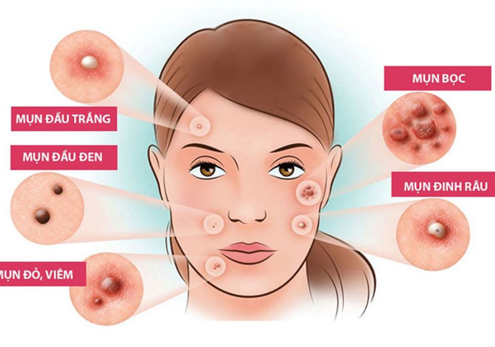 Nguyên nhân gây Mụn và cách xử lý