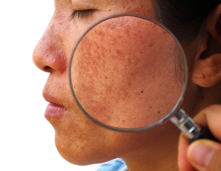 NÁM VÀ HƯỚNG ĐIỀU TRỊ HIỆU QUẢ