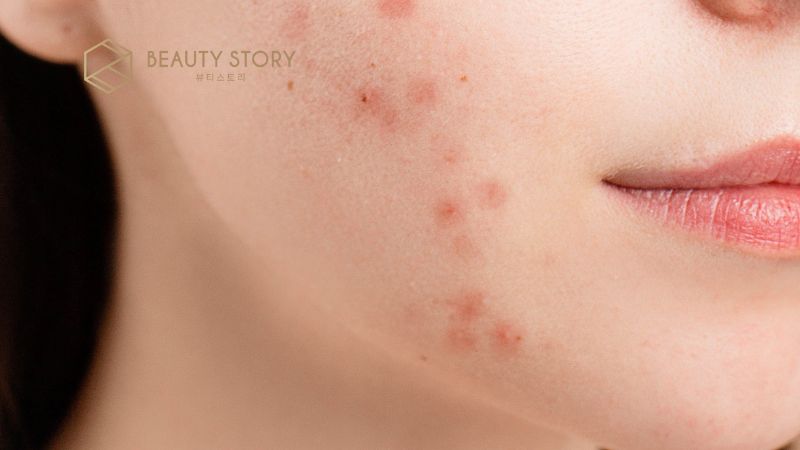 Mụn mọc ở cằm liên tục: Do nội tiết hay do vệ sinh da sai cách?