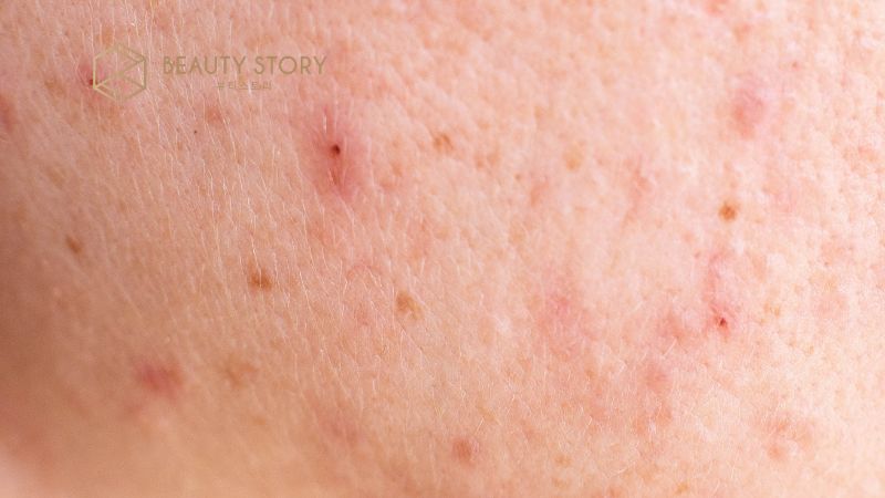 Mụn nội tiết? Cách điều trị dứt điểm từ gốc cho nữ