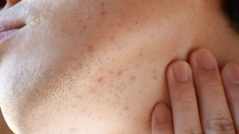 Quy trình skincare cho da mụn ẩn