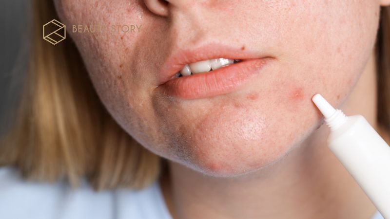 Serum trị mụn ẩn