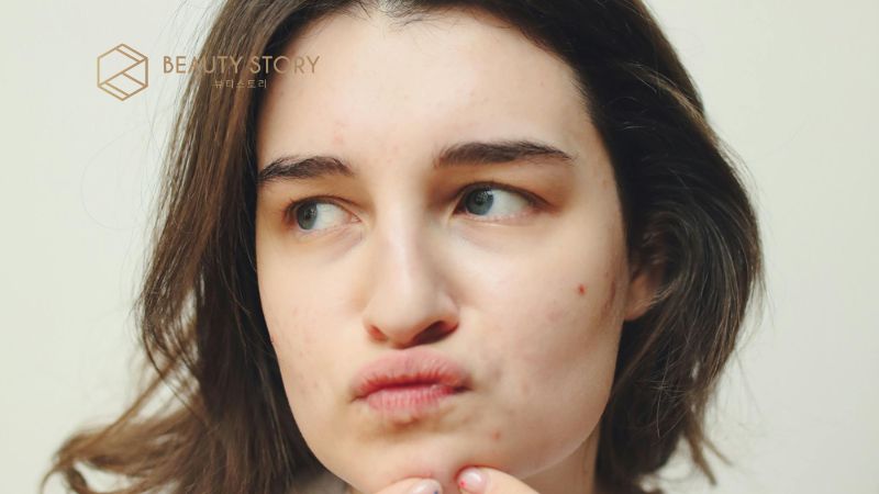 Tại sao hay bị mụn ở cằm